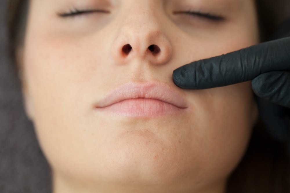 láser lift lip cirugía estética