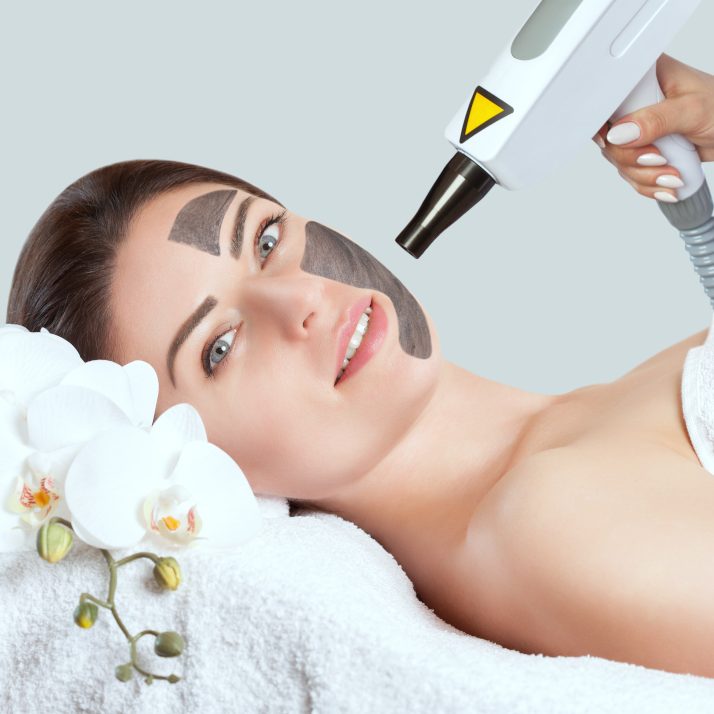 carbon peel flash laser Synchro QS4