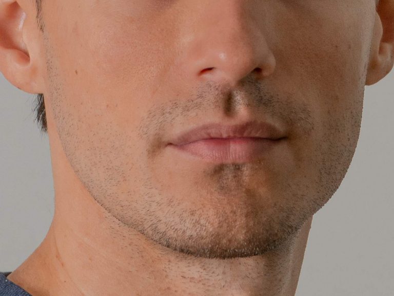 masculinización facial para hombres mandíbula mentón