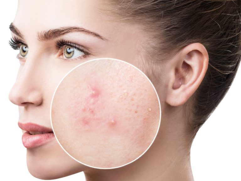 tratamiento del acné dermatología estética