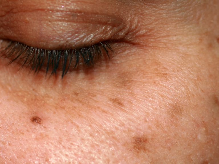 léntigos manchas solares dermatología estética