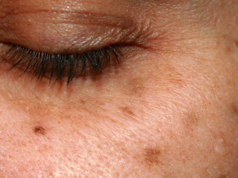 léntigos manchas solares dermatología estética