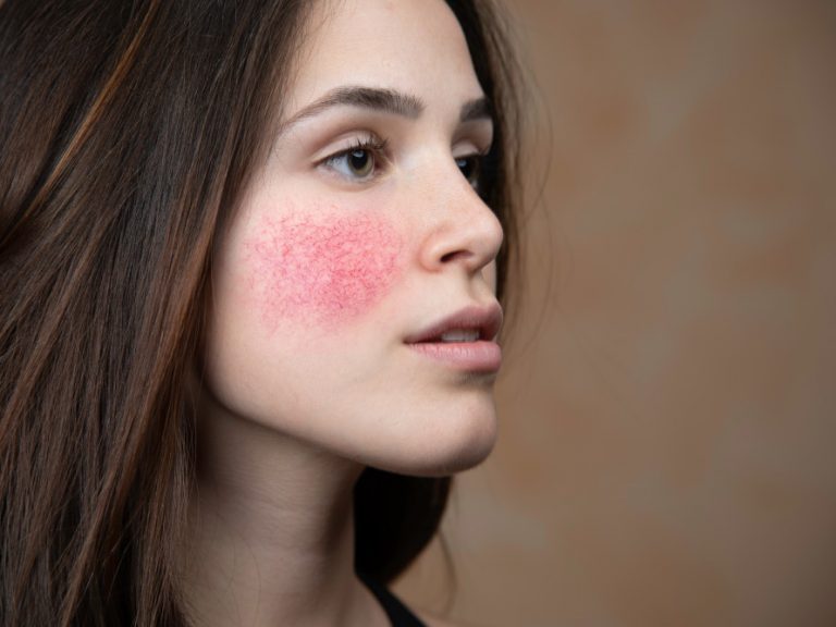 rosácea dermatología estética