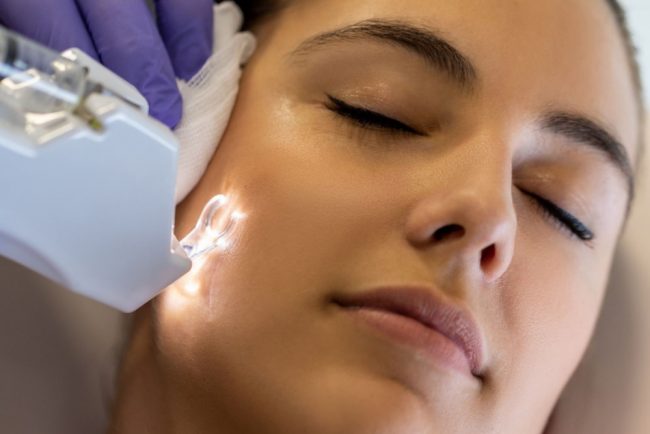 como-eliminar-cicatrices-del-acne cómo eliminar las cicatrices del acné medicina estética