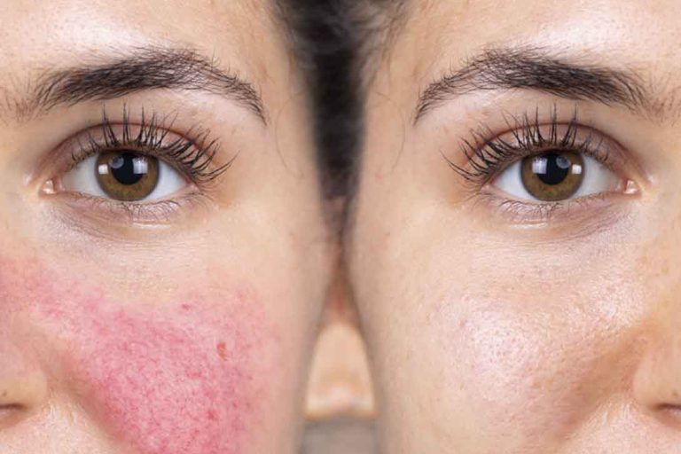 cómo controlar brotes de rosácea
