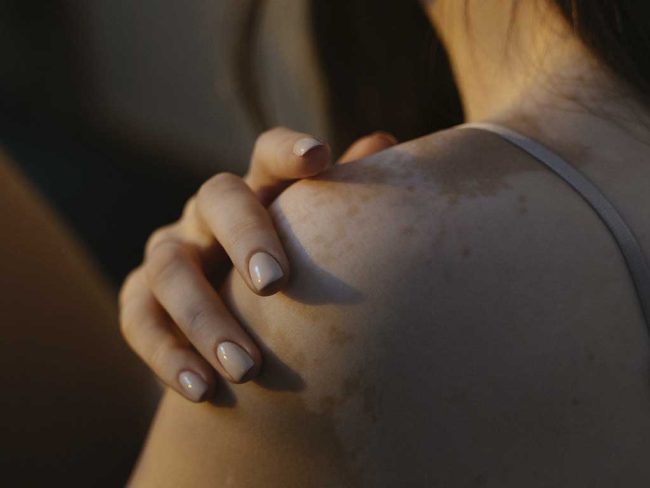 problemas de la piel que mejoran en verano