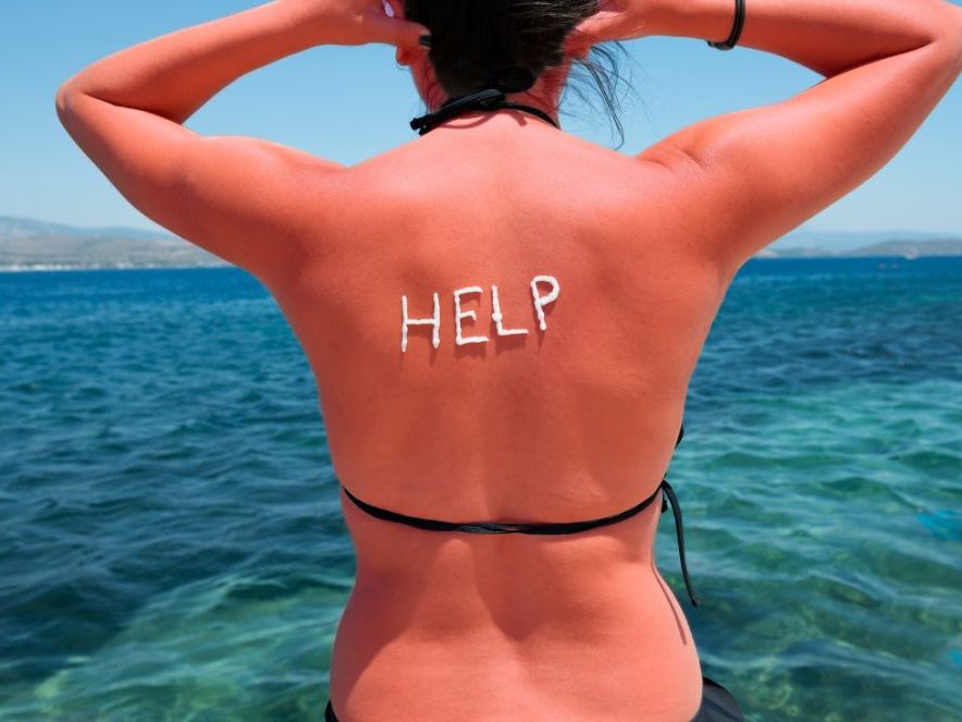 tratamiento de las quemaduras solares