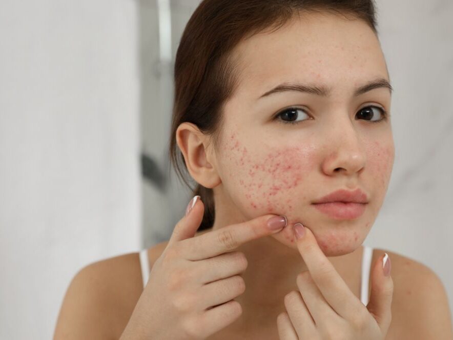 eliminar-cicatrices-acne-medicina-estetica cómo tratar cicatrices acné medicina estética